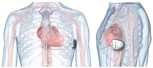 Herzschrittmacher-Macher